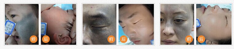 广州哪家医院治太田痣效果好