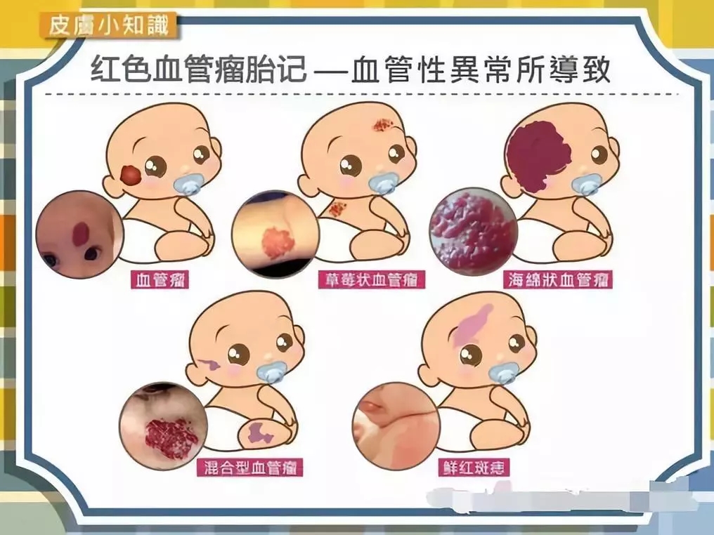 孩子有血管瘤广州哪里能看
