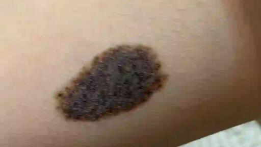 宝宝长黑毛痣的原因